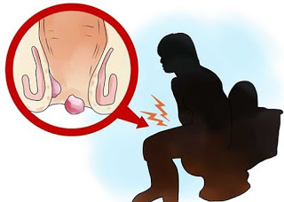 Apakah benjolan wasir bisa sembuh, obat buat penyakit wasir tradisional paling mujarab, obat untuk mengobati wasir tradisional yang ampuh, efek samping penyakit ambeyen, gejala penyakit ambeyen.com, obat ambeyen di apotik bebas, obat untuk mengobati wasir alami ibu hamil, faktor resiko penyakit ambeien, harga obat buat penyakit ambeien dalam dan luar, alamat pengobatan ambeyen di surabaya, obat wasir atau ambeien wasir untuk ibu hamil